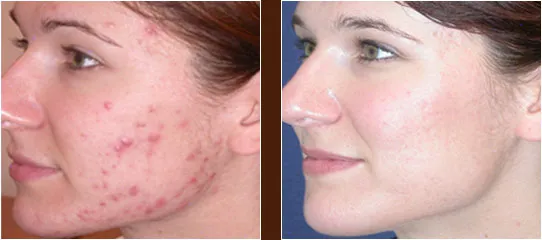 Akne, prej potem