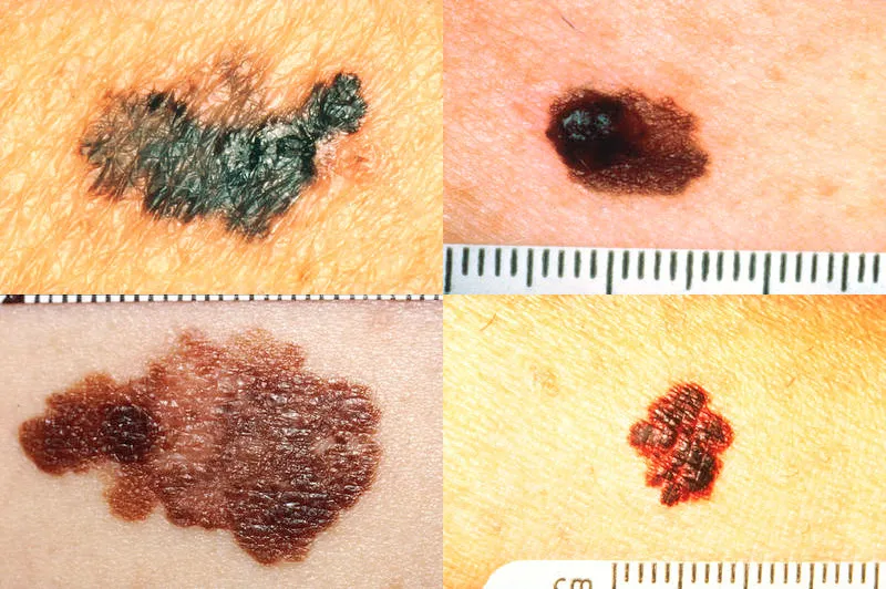 Kožna znamenja dermatološka abulanta