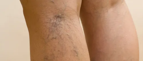 Lasersko odstranjevanje žilic