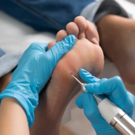 lasersko odstranjevanje bradavic