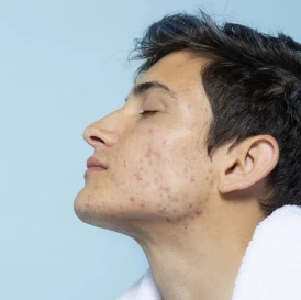 Lasersko izboljšanje kože po aknah